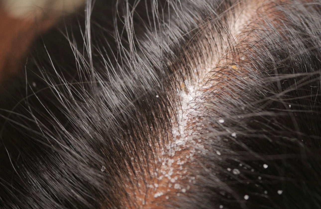 Khushki (Dandruff) Kyun Hoti Hai? 7 Bunyadi Wajuhat Aur Unka Asal Hal