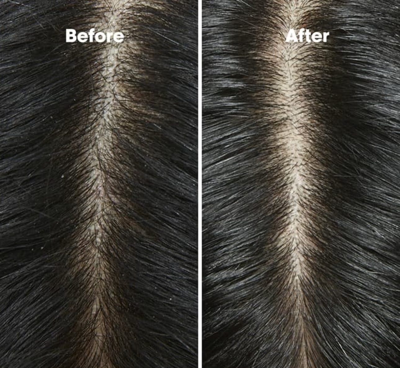 how to remove dandruff fast in 1 day natural treatment pakistan